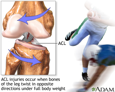 Anterior cruciate ligament (ACL) injury