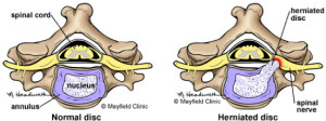 comparison-cervical-normal-disc-vs-herniated-disc